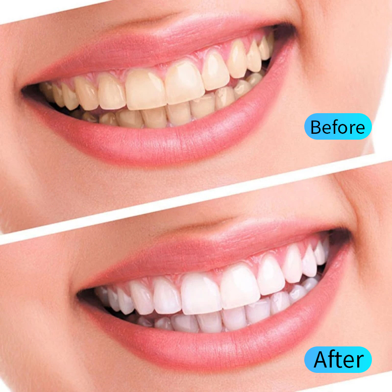 Teeth Whitening Gel Kit Oral H - Teeth Whitening Opalescence recension och pris