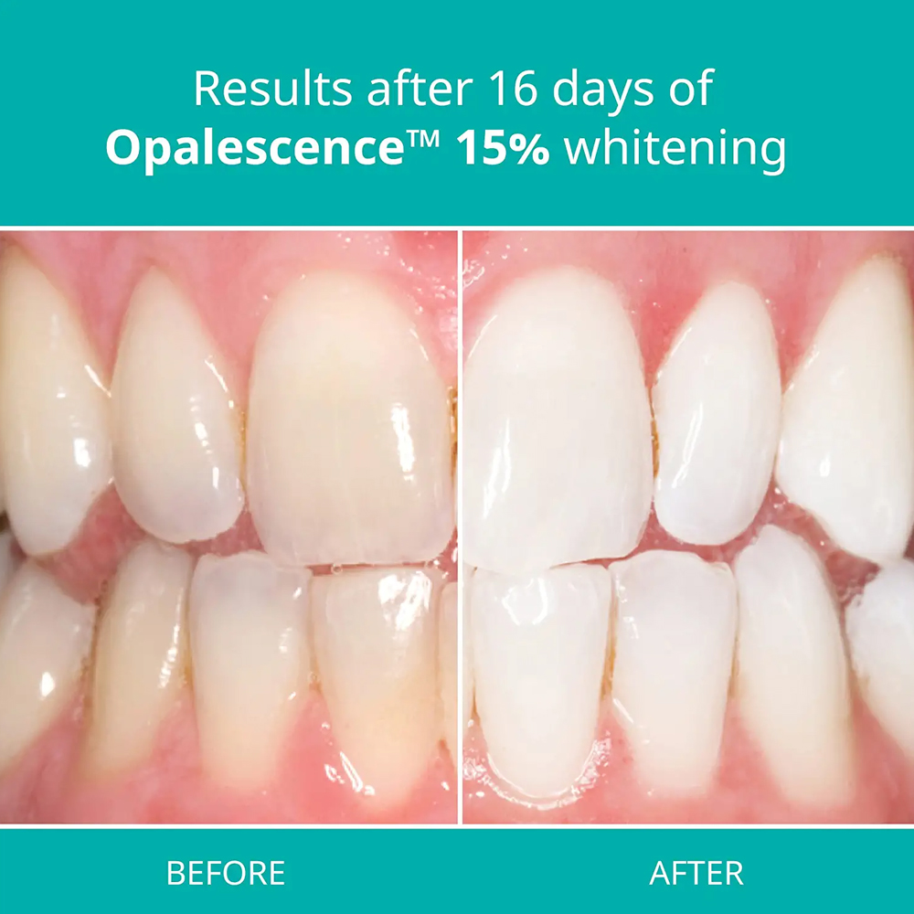 Opalescence Professional White - Teeth Whitening Opalescence recension och pris