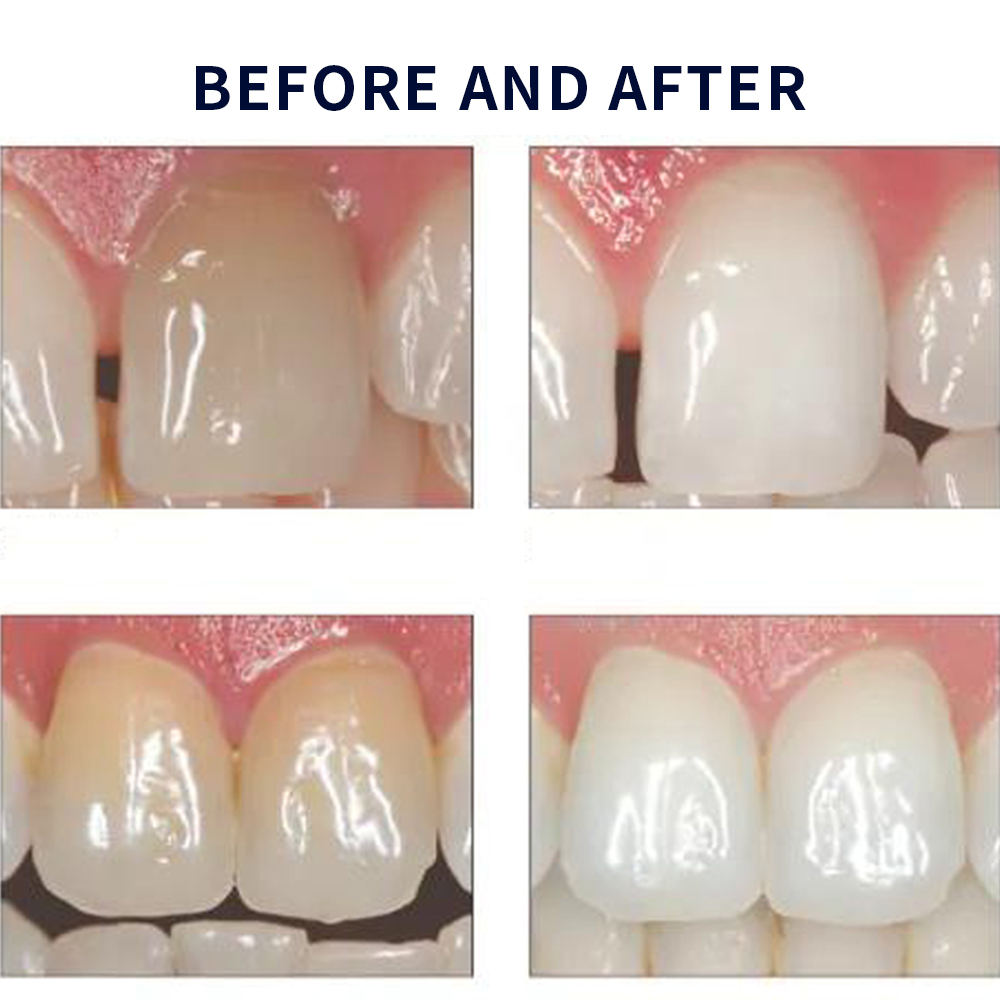 Opalescence Whitening 20% PF 2 - Teeth Whitening Opalescence recension och pris