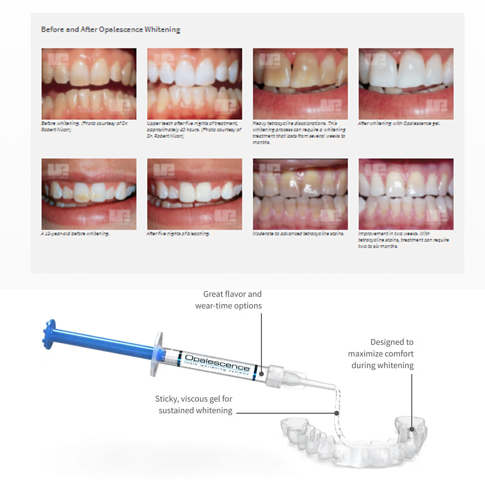 Opalescence Whitening 20% PF 2 - Teeth Whitening Opalescence recension och pris
