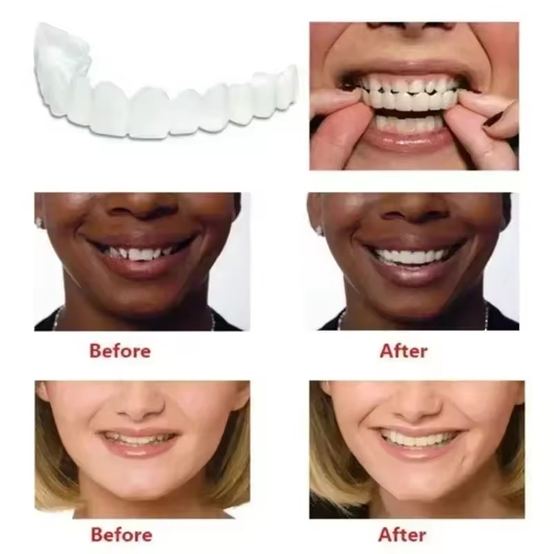 Teeth Veneers Whitening Dentur - Teeth Whitening For Braces recension och pris