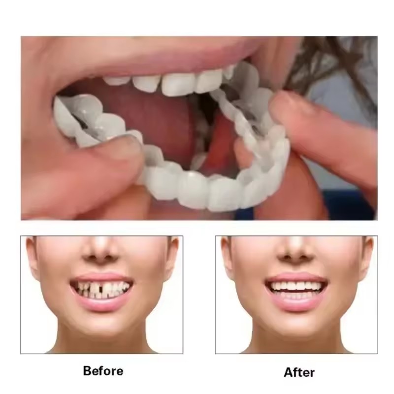Teeth Veneers Whitening Dentur - Teeth Whitening For Braces recension och pris