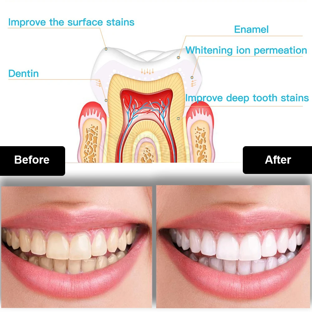 Dental Teeth Whitening Kit Min - Teeth Whitening Zoom recension och pris