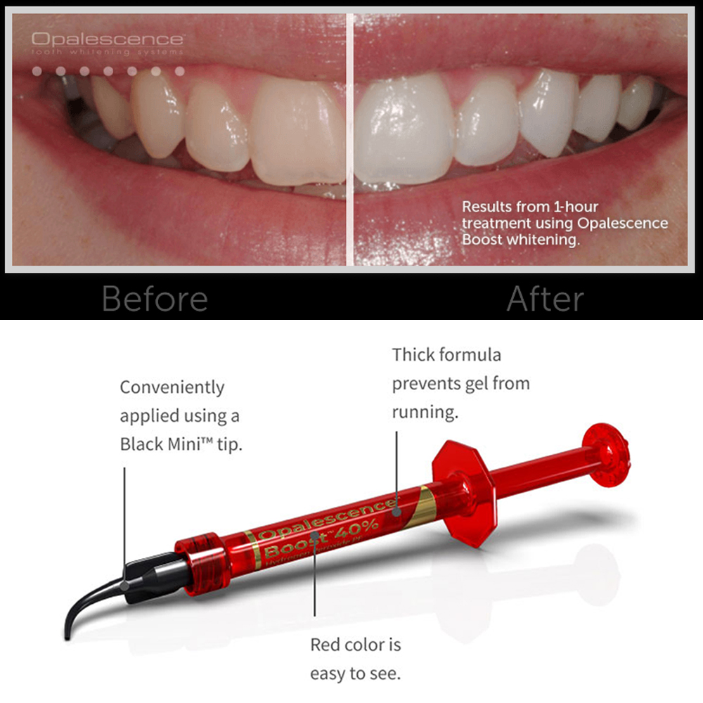 Ultradent Opalescence Boost PF - Teeth Whitening Opalescence recension och pris