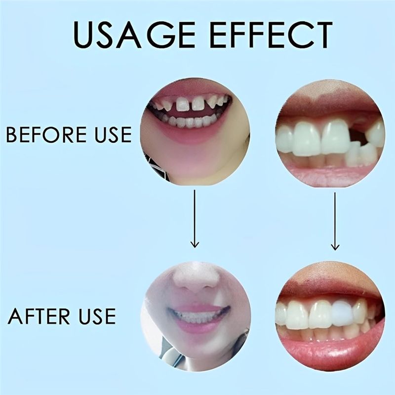 [NEW!ABMK】 2 Pairs,Regain Beau - Teeth Whitening For Braces recension och pris